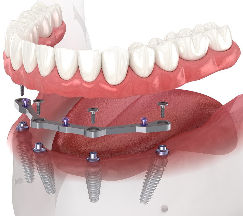 Mandibular,Prosthesis,With,Gum,All,On,4,System,Supported,By